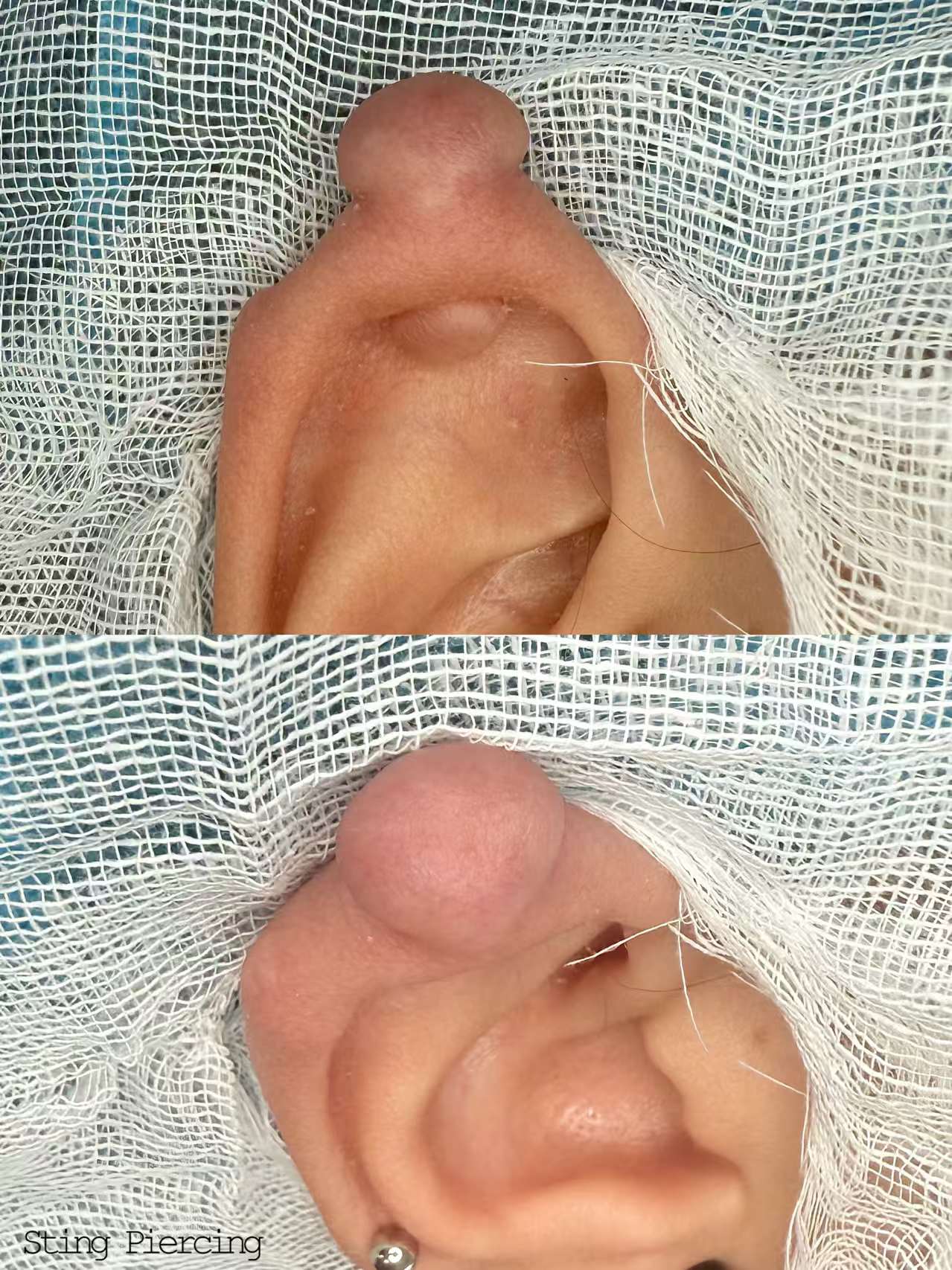 增生切 Keloid Cutting